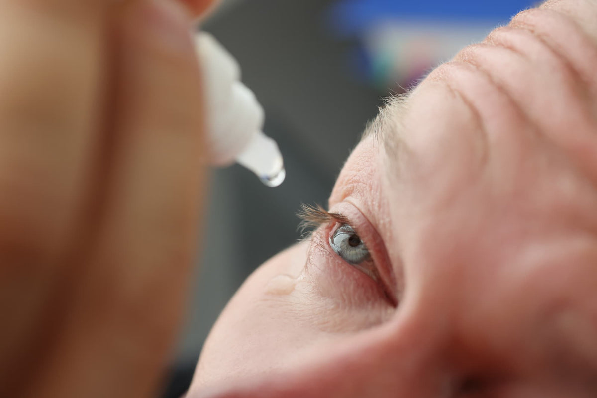 Close-up of a person applying eye drops to an irritated eye as part of blepharitis treatment at home