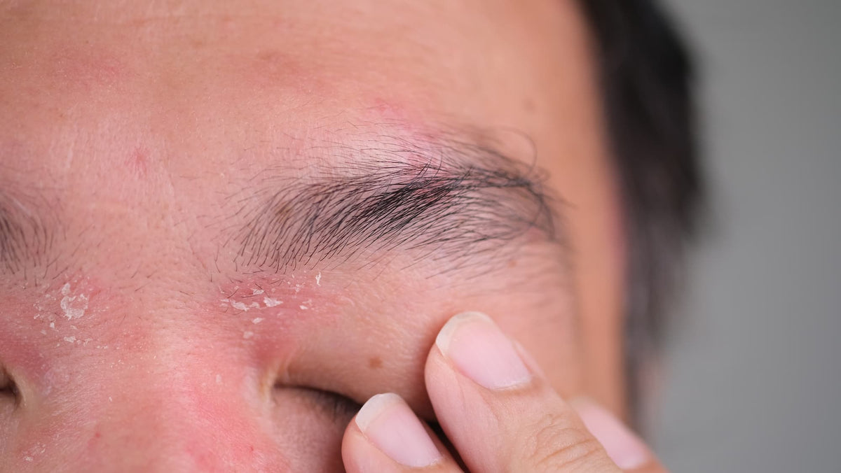 Close-up of red, dry, flaking skin around the eyebrow and eyelid, a common cause of itchy eyelids
